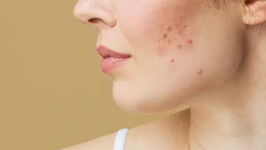 Pimples