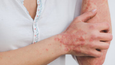 Skin Diseases