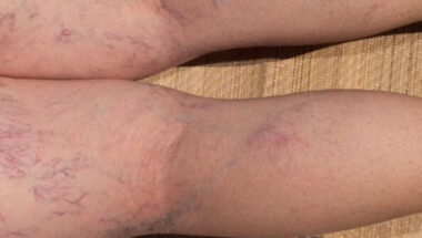 Varicose Vein