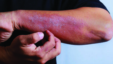 ALLERGY CARE
